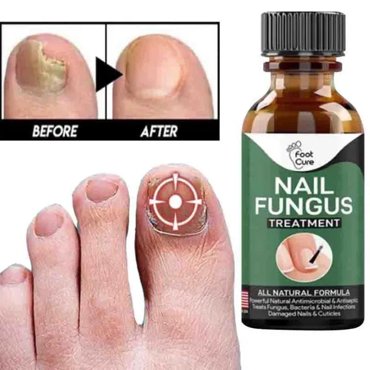 Nail Fungus Removal Gel - Fungal Treatment Serum