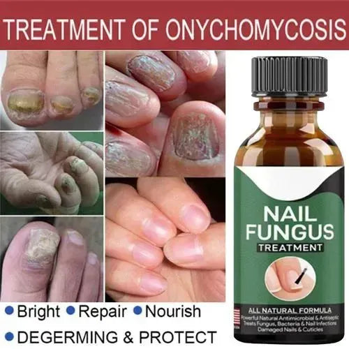 Nail Fungus Removal Gel - Fungal Treatment Serum